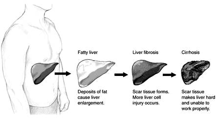 The process of fatty liver that turns into cirrhosis. Liver anatomy picture