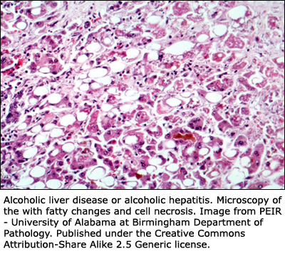Picture of liver with too much fat from drinking too much alcohol.