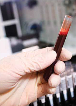 A routine blood test may show elevated liver enzymes. Picture of blood vial.