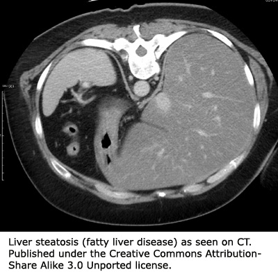 CT scan of a liver with fatty liver disease.