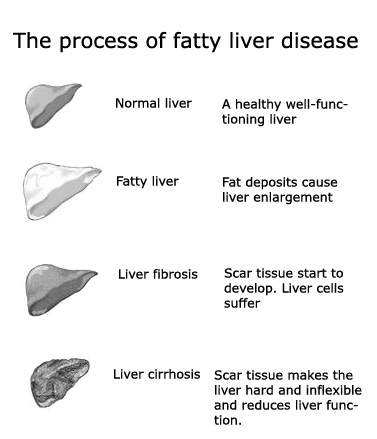 The process of fatty liver disesase to cirrhosis.