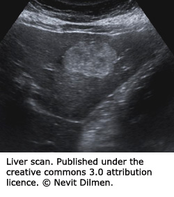 An ultrasound of your liver may show too much fatty tissue in the liver. 